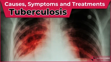 Tuberculosis article header – First Aid Article in Box Hill